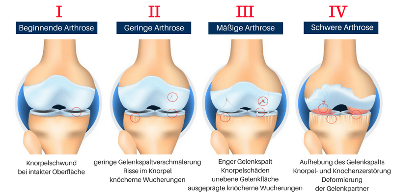 Arthrosestadien800x400-klein